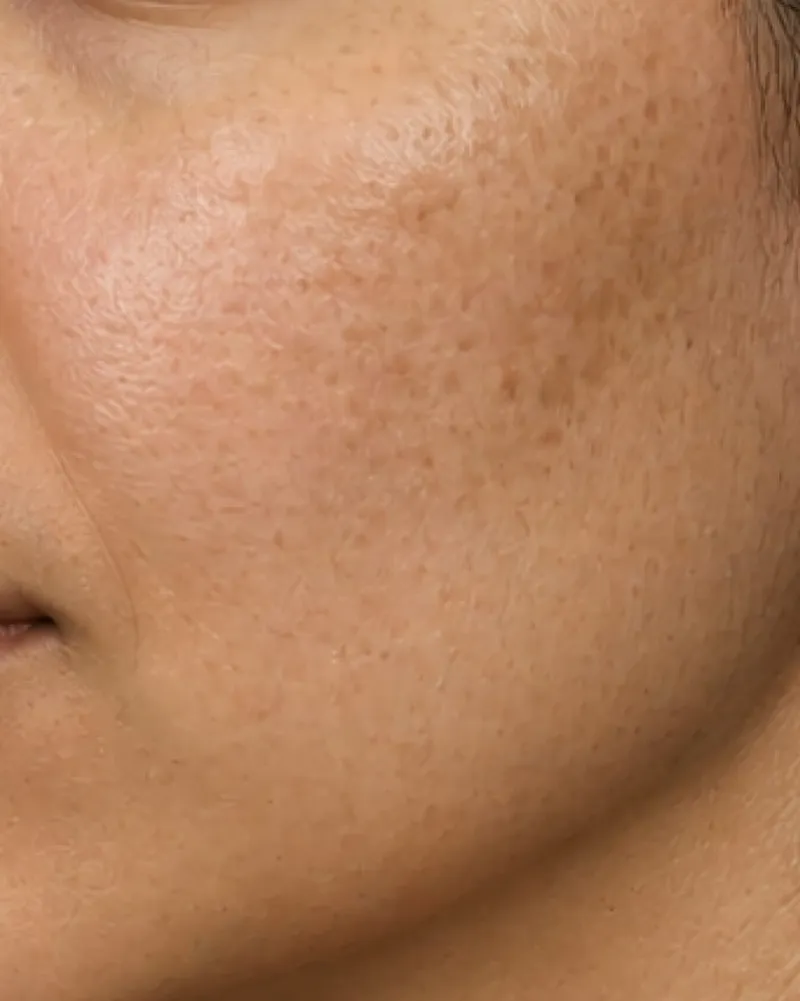 Laser Skin Rejuvenation before
