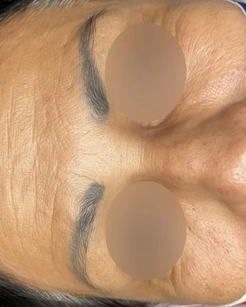 Permanent Makeup Removal before