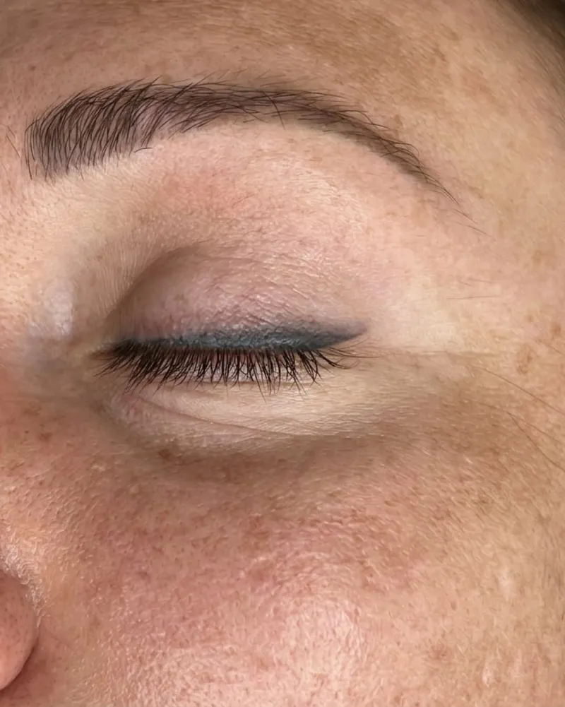 Permanent Makeup Removal before