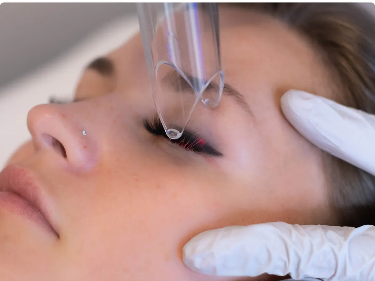 Laser Permanent Makeup Removal