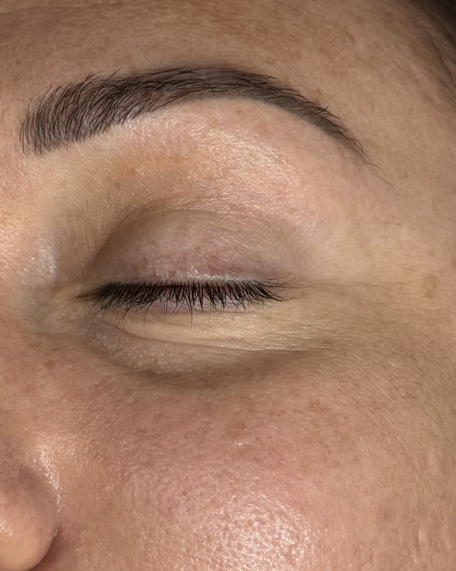 Permanent Makeup Removal after