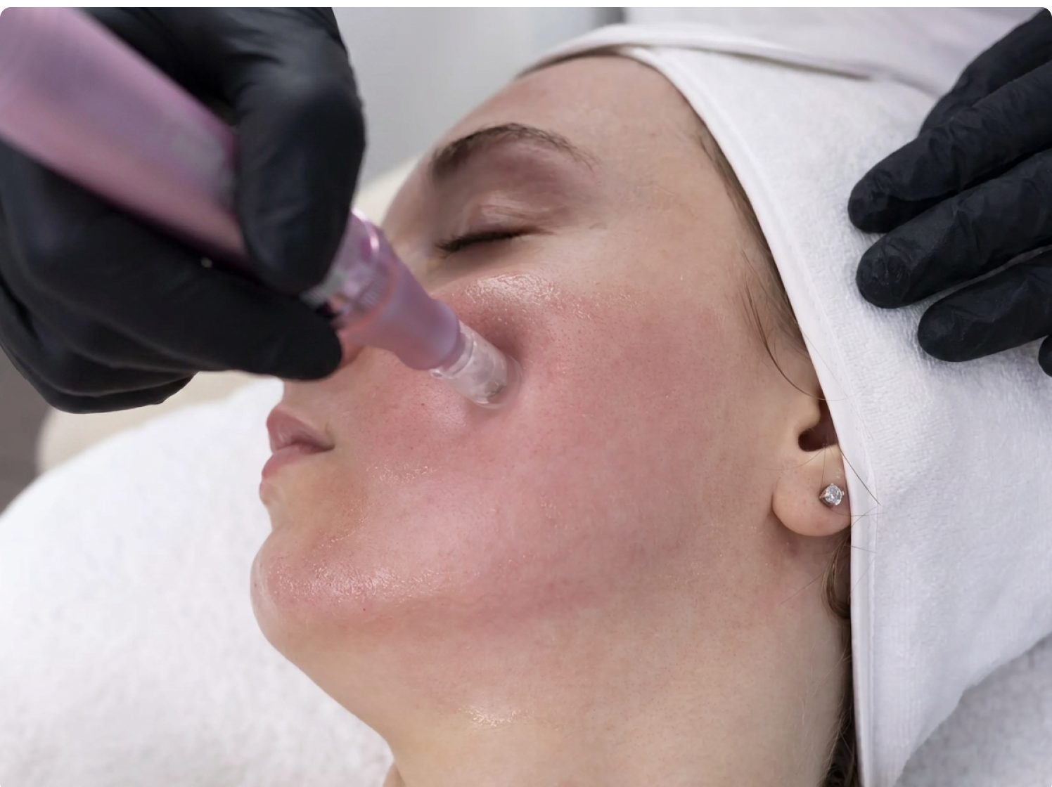 IPL Photofacial