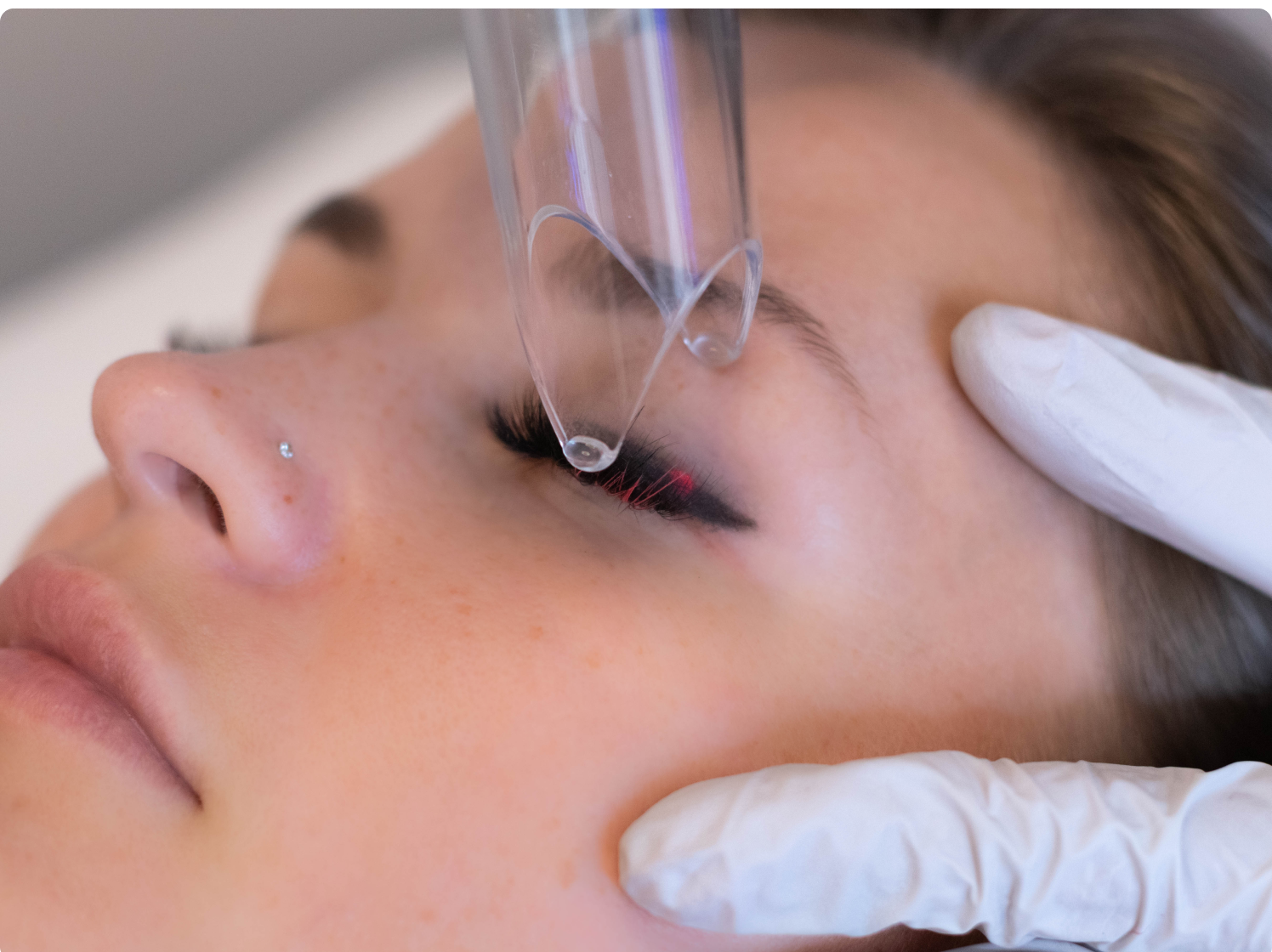 Laser Permanent Makeup Removal